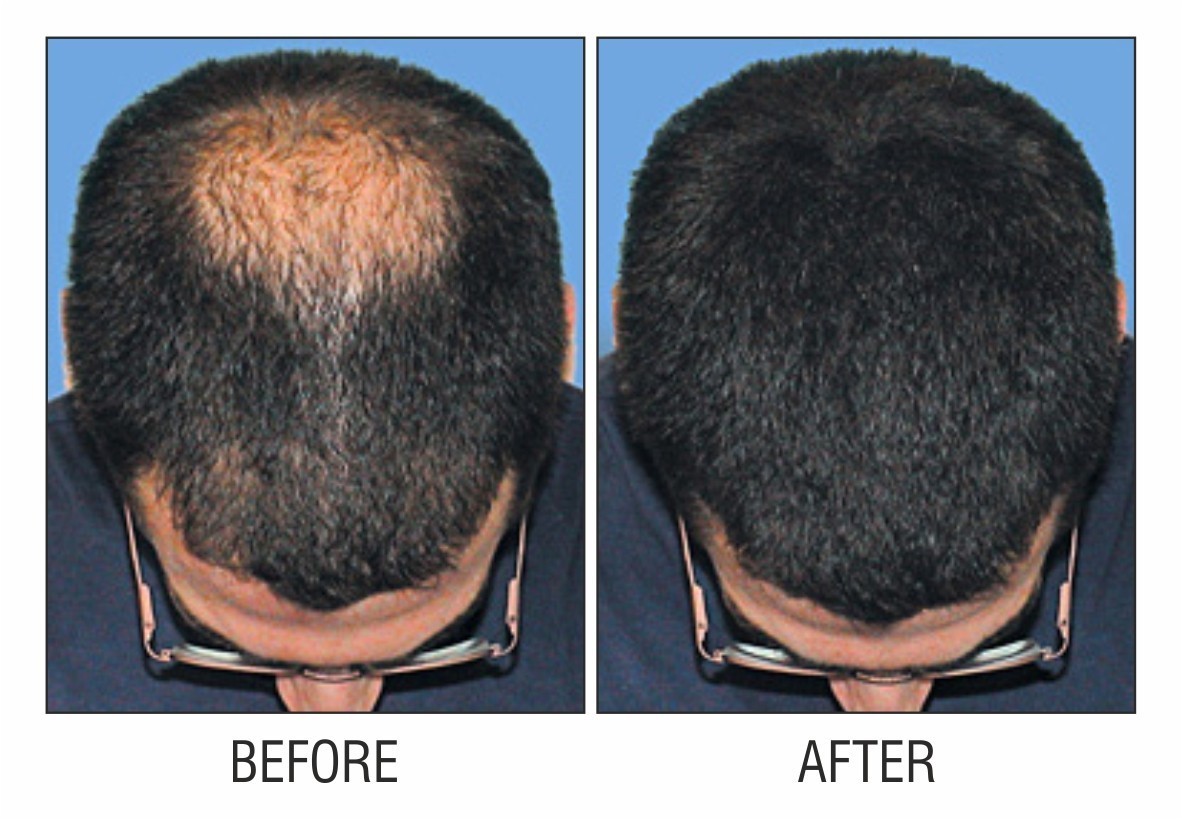 IS NON-SURGICAL HAIR REPLACEMENT BETTER THAN A HAIR TRANSPLANT?