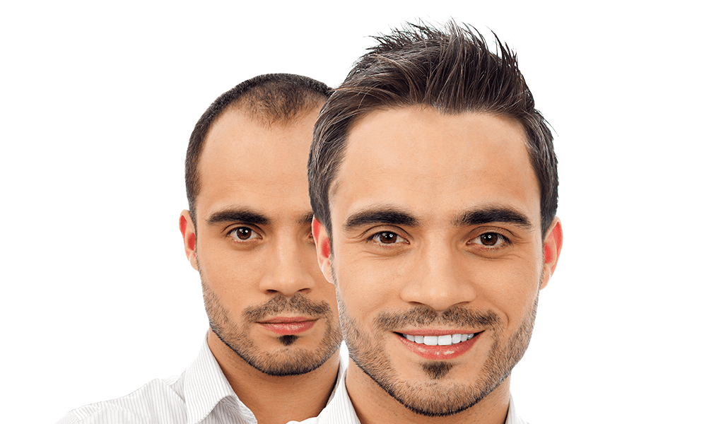 WHAT IS A HAIR PATCH and HOW LONG IT WILL BE?
